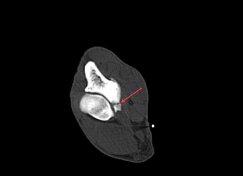 CT SCAN of elbow